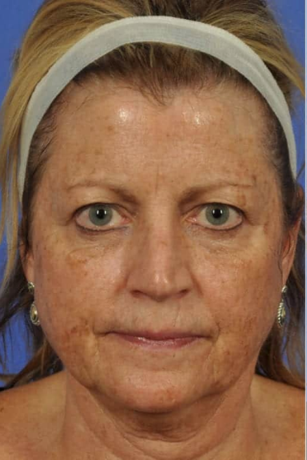 Before Skin Lightening Treatment