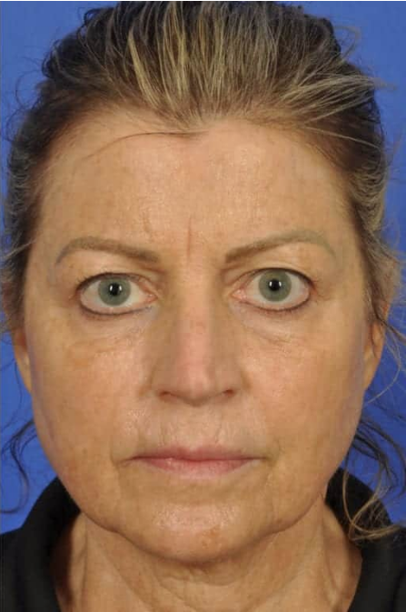 After Skin Lightening Treatment
