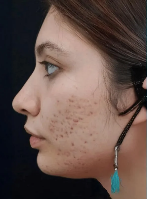 Before Acne Scar Treatment