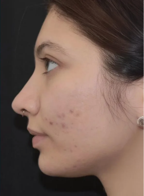 After Acne Scar Treatment