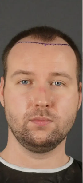 Before Hair Transplant