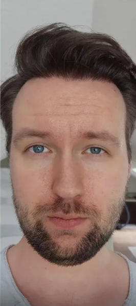 After Hair Transplant
