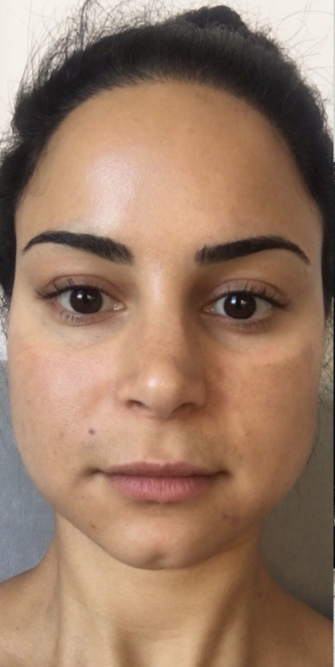 Before Botox Treatment