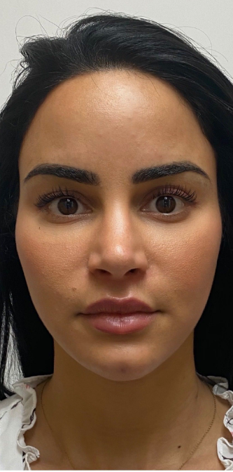 After Botox Treatment